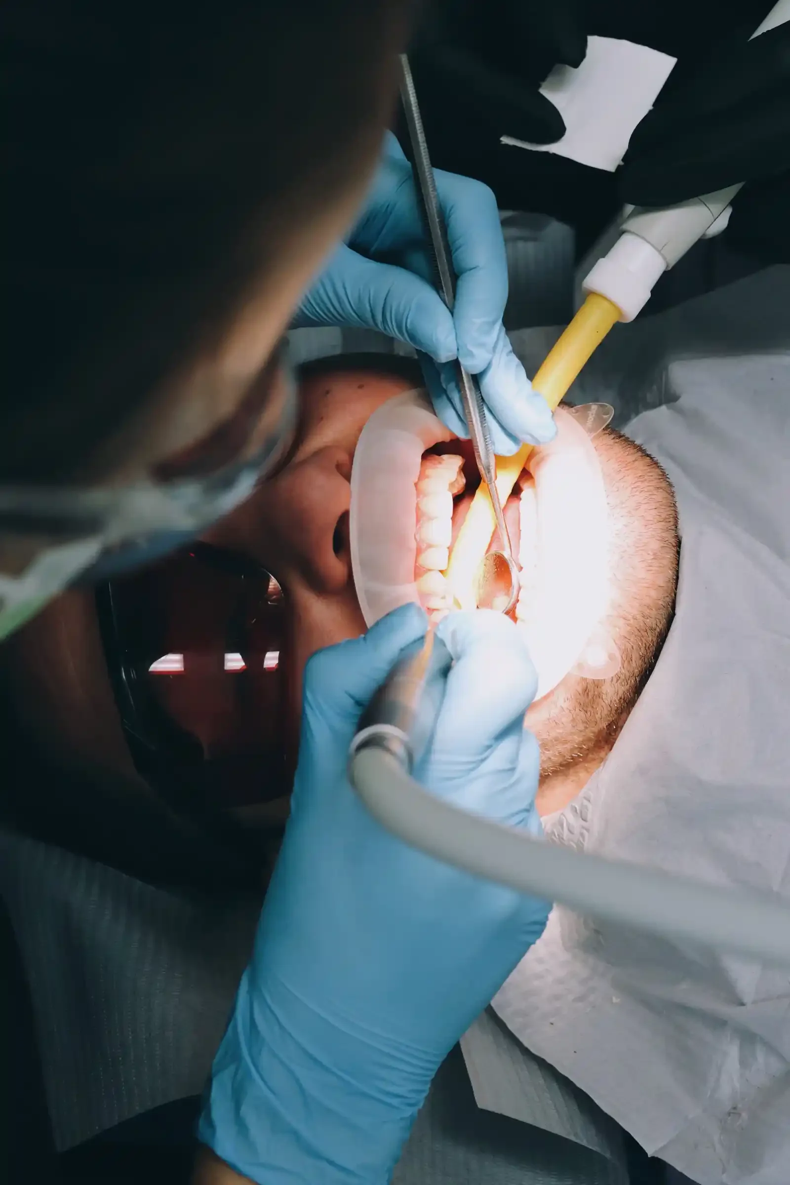Zabieg bondingu zębów w Bas Clinic we Wrocławiu